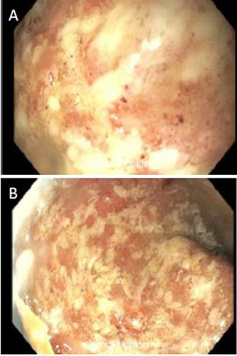 Figure 4 Erythema, friability, and deep ulcerations in the rectum and sigmoid colon on colonoscopy (A and B).