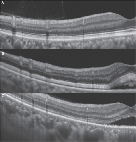 Figure 6 Comparison of SS-OCT images of the outer retinal layer between normal eyes (A), our current case (B) and a patient with central serous chorioretinopathy (CSC) (C). Compared to the normal eye (A) or a case with CSC (C), our case (B) exhibited a thickened photoreceptor outer segment. The heights between the ellipsoid zone and the retinal pigment epithelium of average central zone thickness were 41 μm in the normal eye, 76 μm in our case, and 40 μm in the CSC case.