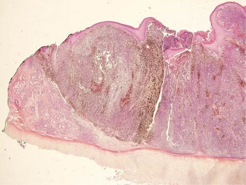 Figure 2 Infiltration of the right nasal cavity wall with a melanoma arriving in depth to the cartilage without invading it.