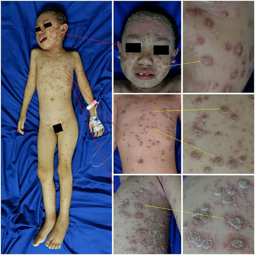 Figure 2 Clinical manifestation of OP. Erythematous plaques with hyperkeratotic scales resembling an oyster shell.