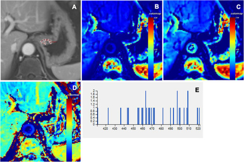 Figure 3 Male, 65 years old. The pathological diagnosis is poorly differentiated adenocarcinoma. The lesion invades the muscular layer of the cardiac wall and is determined to be T2 stage. (A) ROI was manually drawn on whole lesions in late arterial phase. Corresponding parametric maps of Ktrans (B), Kep (C) and Ve (D) are created automatically. The corresponding mean values of Ktrans, Kep and Ve are 0.570 /min, 1.418 /min and 0.402, respectively. The histogram of tumor (E) demonstrates that the skewness, kurtosis and entropy are 0.315, 0.147 and 5.595, respectively.