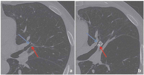 Figure 1. Example of an incomplete occlusion of the lingula. (a): LB4 (red arrow) and LB5 (blue arrow) before treatment. (b): The EBV was supposed to occlude both segments, but occluded only LB4, thus preventing the occurrence of a full lobar atelectasis