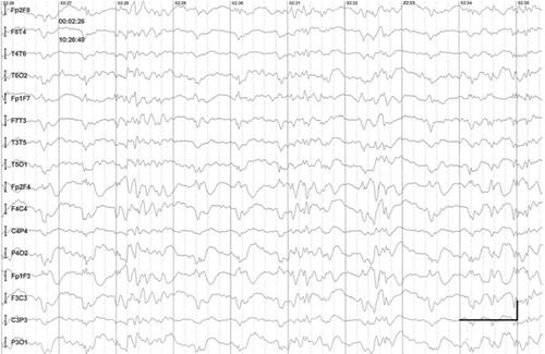 Figure S1 Absence status epilepticus in patient 2. Vertical bar - 100uV, horizontal bar - 1 sec.