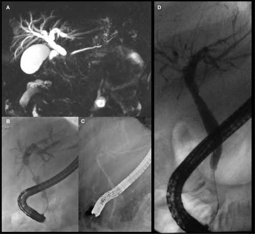 Figure 3 Patient with IgG4 cholangiopathy and painless obstructive jaundice.