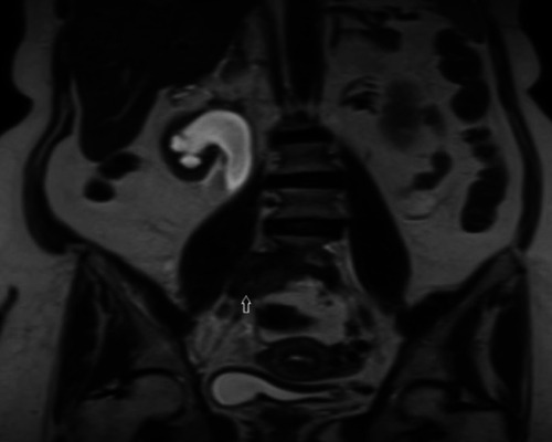 Figure 1 MR Urography revealed right-sided moderate to severe hydronephrosis and moderate hydroureter to mid ureter, secondary to an extrinsic paravertebral soft tissue mass (arrow) (measuring approximately 2×2.7×3.8 cm), encasing the ureter at the level of the right iliac vessels bifurcation.