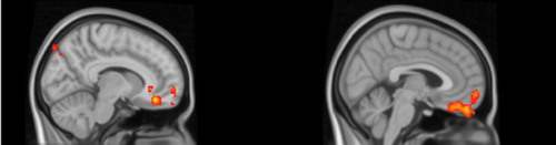 Figure 1. Anterior Cingulate Cortex (right) and medial frontal cortex (right) are the identified areas showing greater activation in children with ADHD compared to the controls.