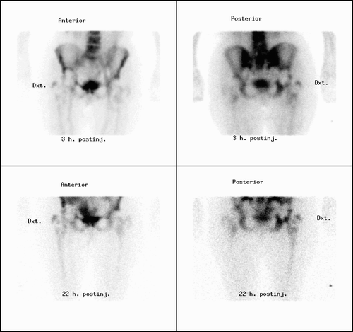 Figure 2. White blood cell scintigraphy showing an infected hip prosthesis. Anterior and posterior images of the hips in a patient with a 5-year-old right-sided total hip prosthesis. There is an abnormal distribution of 99mTc-HMPAO leukocytes around the right femoral component. Note that the pathological leukocyte distribution increased from the image obtained 3 h after the injection to the image obtained 22 h after the injection.