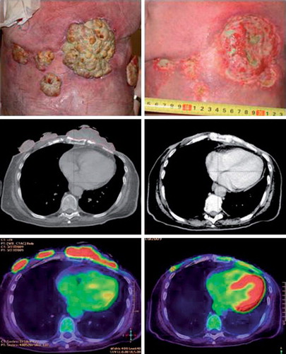 Figure 3. Patient treated with electrochemotherapy. Sixty-four-year-old woman with loco-regional recurrence of bilateral receptor negative, HER2 – negative breast cancer. Previous treatments over a period of five years included radiotherapy 48 Gy in 24 fractions on both sides and reirradiation with 30 Gy in 10 fractions on the left side, systemic therapy (cyclophosphamide, epirubicin, fluorouracil, docetaxel, gemcitabine, vinorelbine, and capecitabine). Despite all these treatments there was continuous progression of the cutaneous lesions. The column on the left shows image of lesions, CT-scan and PET/CT-scan before treatment scan, column on the right shows image of lesion, CT-scan and PET/CT-scan after two sessions with electrochemotherapy.