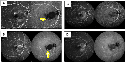 Figure 6 FFA/ICGA images at baseline and post-injections showing PL regression.