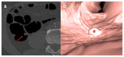 Figure 4 Sessile polyp of the ascending colon: a) native axial image (red arrow), b) virtual endoscopic view (red asterisk).
