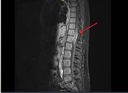 Figure 1. Patient 1. Sagittal T1-weighted MRI showing an intra medullary spinal cord lesion from T10 to L1 levels (arrow).
