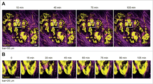 Figure 3. Single tumor cell migration in pancreatic carcinoma. Time-lapse intravital imaging of a genetic fluorescent mouse model of pancreatic cancer with tumor cells shown in yellow and collagen I in magenta. (A) Example of an imaging field (showing 4 time points (30 minute interval)), in which polar and elongated single cell migration was observed (boxed area is enlarged in B). Scale bar, 50 µm. (B) Boxed area in (A)showing migrating polar and elongated single tumor cells (in dashed circles) with a track (last time point, white line). Scale bar, 20 µm.