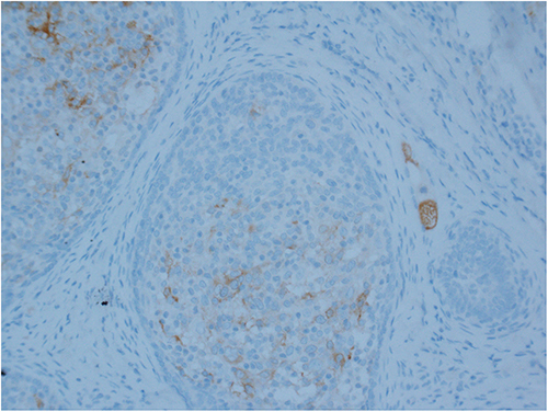 Figure 4 EMA-positive staining of the ductal structures. (Magnification ×200).