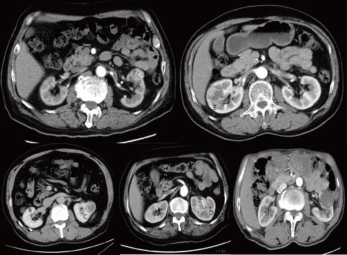 Figure 1 Predictive features on CT imaging as assessed: (A and B) exophytic properties; (C) necrosis and well-defined tumor contour; (D) ill-defined tumor contour; and (E) collecting system oppression.