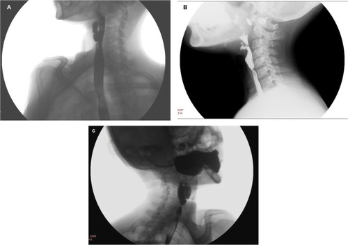 Figure 2 Lateral view of barium swallow study showing esophageal web on (A) anterior wall, (B) posterior wall, and (C) a circumferential web.