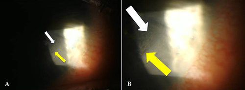 Figure 3 Slit lamp image of DLK observed after SMILE. White arrow indicates DLK, while yellow arrow indicates the SMILE incision; (B) illustrates a magnified depiction of (A).