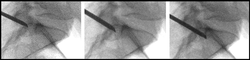 Figure 13 Lateral view fluoroscopic image showing progression of the trocar towards the posterior aspect of the S1 vertebral body while simultaneously advancing the trocar from the lateral to medial S1 pedicle border.