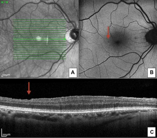 Figure 3 Dissociated optic nerve fiber layer (DONFL). Infrared reflectrance (A), blue light autofluorescence (B) and spectral-domain optical coherence tomography (C) of a post-surgical case of DONFL. The red arrow identifies a “dimple” in the inner retinal layer that corresponds to the hypofluorescent spot.