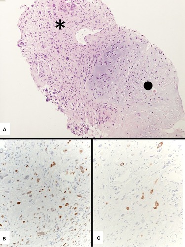 Figure 11 A generous transthoracic biopsy consistent with a carcinosarcoma showing an undifferentiated spindle cell carcinoma (asterisk) and a heterologous chondrosarcoma (dot) (A). Immunostains with pan-cytokeratins (clone MNF116) (B) and TTF-1 (clone 8G7G3/1) (C) demonstrate the epithelial adenocarcinomatous differentiation of the spindle cell component.