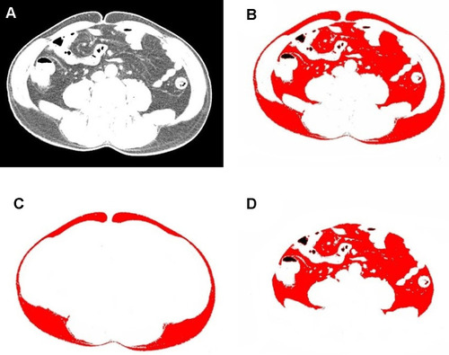 Figure 1 (A) CT image at the umbilical level. (B) The red part shows the total fat area (TFA). (C) The red part shows the subcutaneous fat area (SFA). (D) The red part shows the visceral fat area (VFA).