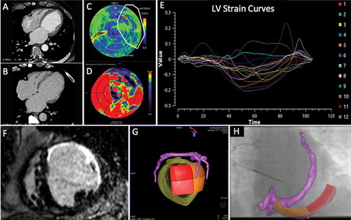 Figure 5. Series of (Dual Energy CT) DECCT-derived scar and image overlay of the coronary sinus and optimal target segment derived from CT strain measurements from one patient: Retrospective CCT demonstrating calcification in a left anterior descending (LAD) and circumflex territory infarct (A). Dual-energy CCT demonstrating subtle ventricular scar in the LAD and circumflex territory (B). Late iodinated enhancement plotted on American Heart Association (AHA) 17-segment bull’s-eye plot suggesting scar in the LAD and circumflex territory but also artifact from an existing RV pacing lead in the basal to mid-antero-septum (C). First pass iodine uptake plotted on an AHA 17-segment bull’s-eye plot showing what we believe to be residual iodine predominately in the LAD and circumflex territory (D). CCT-derived dyssynchrony curves calculated by myocardial strain (E). Cardiac magnetic resonance short axis image of the mid-LV showing late gadolinium enhancement of the same patient taken 2 years prior to any device implantation for comparison purposes (F). Pre-procedure DECCT-derived coronary sinus segmentation fused with latest mechanical activating segments determined from DECCT-derived strain (G) co-registered and overlaid onto live fluoroscopy using fusion software (H). Reproduced with permission from Oxford University Press.