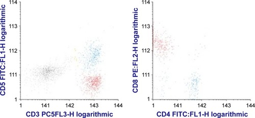 Figure 2 Dot plot histograms showing atypical suppressor CD5−CD3+CD8+ T cells (in red) and normal CD3+CD5+ T-cells (blue).