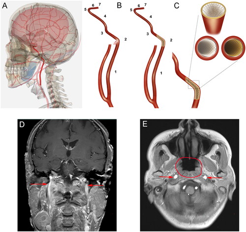 Figure 1. (A) Schematic diagram of the internal carotid artery in the human body (highlighted: internal carotid artery); (B) The seven segments of the internal carotid artery are shown with different marks. The left image shows the rupture and bleeding of the C2 segment of the blood vessels. The image on the right shows bleeding stopped after stent implantation; (C) A local magnification shows the use of a stent to treat an internal carotid rupture. The lower right image shows a cross-sectional view of an ordinary stent implant. The lower left image shows a cross-sectional view after the covered stent is implanted, and a white membrane is visible between the vessel wall and the stent; (D) Coronal plane and (E) axial plane: The carotid arteries and neighboring anatomic structures are shown (arrows indicate the internal carotid artery; circle shows the nasopharyngeal area).