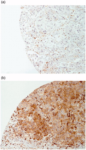 Figure 1. Immunohistochemistry images (×20 magnification): (a) Negative Bcl-2 expression of tumor cells (lymphocytes are immunoreactive and can be observed), (b) Positive Bcl-2 expression of tumor cells.