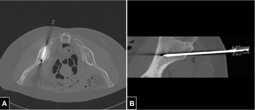 Figure 3 (A and B) Computed tomography-guided microwave ablation of metastasis from breast carcinoma of the left iliac bone in a 54-year-old woman. The patient stands prone and the tip of a 14 gauge needle is inserted into the lesion.