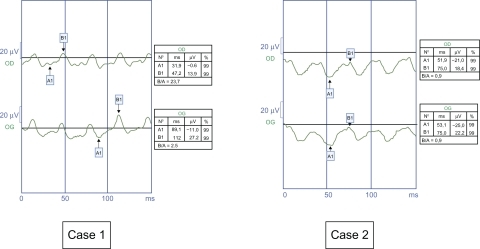 Figure 7 Case 1. Amplitude of the flicker response is 12.3 μV in the right eye and 16.2 in the left eye. Case 2. Amplitude of the flicker response is 2.6 μV in the right eye and 2.8 μV in the left eye. These results are compatible with incomplete congenital night stationary blindness.