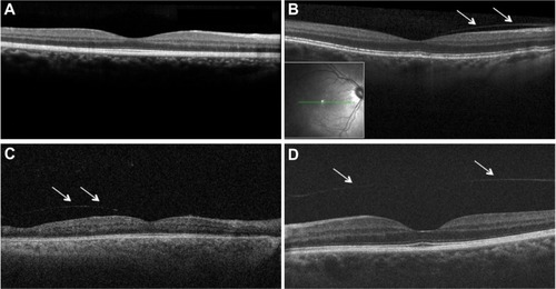 Figure 1 Images of macular region on spectral domain and swept source optical-coherence tomography (A, B, D: Spectralis OCT, Heidelberg Engeneering, Heidelberg, Germany; C: SS OCT; CArl Zeiss, Oberkochen, Germany).