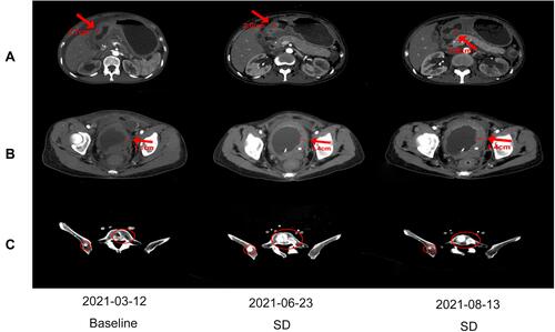 Figure 3 The changes in the lesions observed using CT scans. (A) The changes observed in the gastric antrum wall using three CT scans. (B) The changes observed in the bladder wall using three CT scans. (C) The changes observed in the fifth lumbar metastasis using three CT scans.