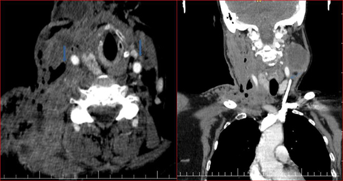 Figure 4 A CT scan of the neck reveals no contrast flow and filling defects in both jugular veins, indicating thrombosis.
