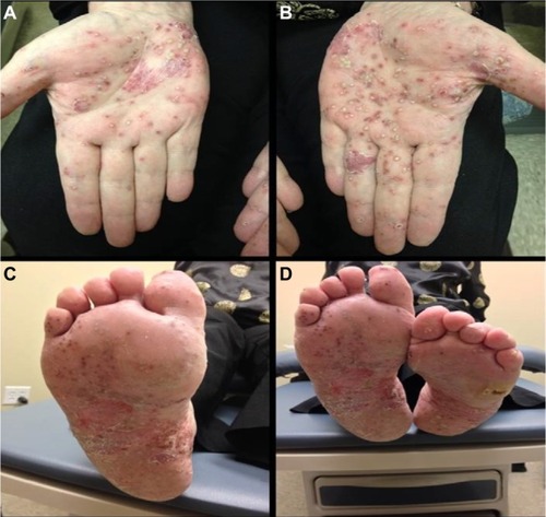 Figure 2 Palmoplantar pustular psoriasis.