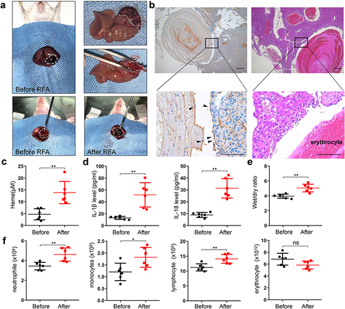 Figure 1 SIRS occurred and heme elevated after RFA of hepatic hemangioma in mice. (a) The orthotopic liver hemangioma model was established, and RFA was performed. (b) The liver hemangioma of mice was stained by CD31 immunohistochemical staining and H&E staining, black arrow indicates the positive CD31 staining. Scale bar = 200 µm. (c) The level of heme in mice was detected after RFA. (d) The levels of IL-1β and IL-18 were detected by ELISA. (e) The wet-to-dry lung ratio was calculated. (f) The neutrophil, monocyte, lymphocyte, and erythrocyte count were examined. There were 6 mice in each group. The data are expressed as mean ± SEM. ns: no significance, *P < 0.05, **P < 0.01.