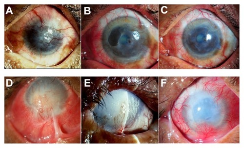 Figure 4 Slit-lamp photographs show a comparison of the eyes before (left column) and after (middle and right column) cultivated limbal epithelial transplantation (CLET) in the histopathologic failure group. Patient 10 (top row) has total limbal stem cell deficiency from a severe chemical burn (A). Postoperatively, the patient has histopathologic failure but clinical success. Cytology shows goblet cells in the central cornea at 12 months, but the central cornea has remained clear with minimal haze and no vascularization. The visual acuity at 13 (B) and 29 (C) months remains 20/125. Patient 9 (bottom row), with limbal stem cell deficiency from a severe chemical burn, has marked lid abnormality and corneal stromal destruction (D). The patient undergoes auto-CLET. Seven months postoperatively (E), the ocular surface has less inflammation and no recurrent symblepharon. However, an epithelial defect persists and does not heal after subsequent tarsorrhaphy surgery. The patient finally undergoes penetrating keratoplasty at 9 months. Complete epithelialization has not been achieved and the clinical course was complicated by secondary infectious keratitis. The corneal graft is then rejected and eventually opaque with complete epithelialization at 30 months (F).