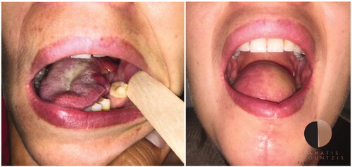 Figure 1. Intra-operative free-flap tongue reconstruction (a) preparation of reconstruction following hemi-glossectomy (b) the radial forearm free flap before implantation 3) pre-operative free flap design.