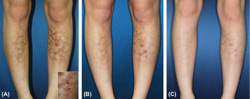 Figure 2. (A) Diffuse reticulated brownish patches with atrophic scars on the anterior aspect of the both lower legs (B) Clinical improvement after first session, and (C) six session of treatments with low fluence 1,064-nm QS Nd:YAG laser (inlet: biopsy sites).