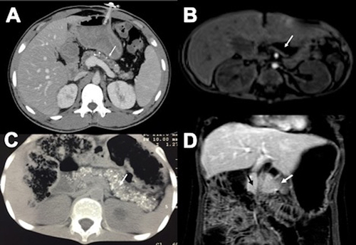 Figure 1 (A) Computed tomography (axial view) of a 8-year-old patient with cystic fibrosis showing pancreatic atrophy and pancreatic calcifications (white arrow). (B) Magnetic resonance cholangiopancreatography (axial view) of an infant with exocrine pancreatic insufficiency from Pearson syndrome showing pancreatic atrophy with fatty replacement (white arrow). (C) Computed tomography (axial view) of a 5-year-old patient with exocrine pancreatic insufficiency from tropical calcific pancreatitis showing extensive pancreatic calcifications (white arrow). (D) Magnetic resonance enterography (coronal view) of a 4-year-old patient with exocrine pancreatic insufficiency showing annular pancreas (white arrow) and pancreatic hypoplasia with small body and tail of the pancreas (black arrow).