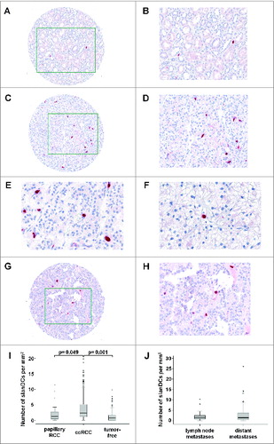 Figure 1. slanDCs accumulate in ccRCC tissues. (A–F) Immunohistochemical stainings were performed to detect slanDCs in primary tumor and tumor-free tissues of ccRCC patients. As representative examples, the presence of slanDCs in a histologically confirmed tumor-free (A, B) and tumor tissue (C, D) is shown. Original magnification was x100 (A, C) or x200 (B, D). (E, F) slanDCs were located interstitially (E) or in blood vessels (F). Original magnification was x400. (G, H) The presence of slanDCs in a histologically confirmed tumor tissue of a patient with papillary RCC is demonstrated. Original magnification was x100 (G) or x200 (H). (I, J) Positively stained slanDCs were counted and their number per square millimeter was determined. (I) Box plots show the number of slanDCs in histologically confirmed primary tumor tissues of ccRCC patients (n = 263) in comparison to tumor-free tissues (n = 227) or primary tumor tissues of patients with papillary RCC (n = 17). (J) Box plots show the number of slanDCs in histologically confirmed lymph node metastases (n = 24) and distant metastases (n = 67). Boxes within the plots represent the 25–75th percentiles. Median values are depicted as solid bold lines. The whiskers represent 1.5 times of the interquartile range (IQR). Circles indicate values more extreme than 1.5 times of the IQR, whereas asterisks illustrate values more than 3 times of the IQR. Statistical significance of differences was calculated by the Mann–Whitney U-test. P values < 0.05 indicate a statistically significant difference.