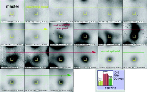 Figure 4.  Screen shot from the PDQuest analysis software showing the inter-individual expression of Spot SSP 7123 through all the match-set members. The arrow lines separate the three sub-entities. The histogram shows the expression levels of the spot SSP 7123 throughout all gels. The highest expression levels are found in the aneuploid cancers (red columns).