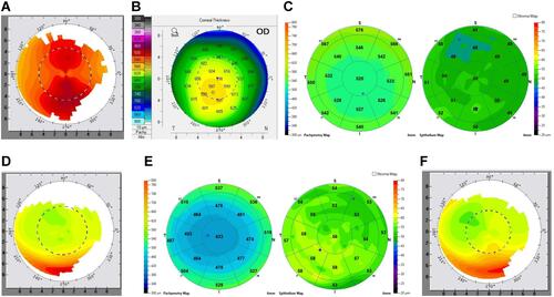 Figure 1 (A and B) Case 1. Pre-op topography and Pentacam pachymetry map. Note the lateralized central thin point relative to the apex, and pre-operative astigmatism. (C) Case 1. Pre-op OCT pachymetry and ETM. Overall relatively regular central epithelial thickness. (D) Case 1. 5 months post-op topography. Note the elliptical, irregular ablation pattern. (E) Case 1. 5 months post-op OCT pachymetry and ETM. Note the irregular thickening of the epithelium at the periphery of the ellipse. (F) Case 1. 2 months post-enhancement topography.