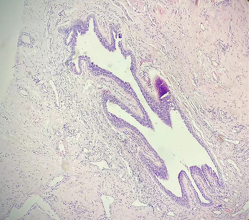 Figure 4 Catheter dilation accompanied by infiltration of acute and chronic inflammatory cells. (H&E staining, 100x).