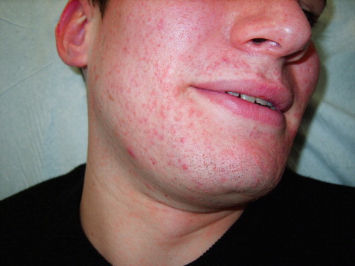 Figure 1. Flat-topped papules and some acneiform lesions on the beard area before the topical and MAL-PDT treatment.