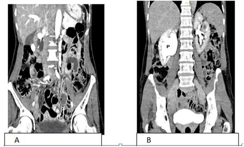 Figure 3 (A) coronal images showed dilated left gonadal vein (G). (B) right UPJO on delayed film with no passage of contrast to right ureter (P).