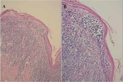 Figure 2 (A) Hyperkeratotic epidermis, mild epidermal thickening, and heterogeneous mononuclear cells in the lower epidermis (HE x100). (B) Cells with large, darkly stained, irregular nuclei with perinuclear halos aggregated into nests resembling Pautereum microabscesses. Banded lymphocytes and histiocytes were observed in the superficial dermis (HE x200).