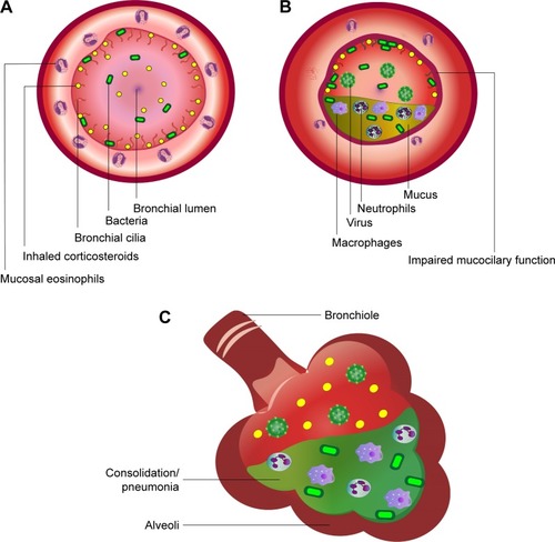 Figure 1 Schematic to show effects of inhaled corticosteroid (ICS) moiety of single triple inhaler therapy in COPD.