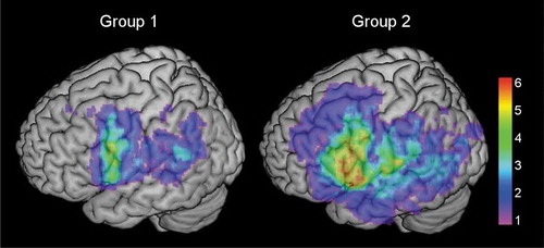 Figure 2. Colorized maps depicting lesion overlaps in the left hemisphere in the high comprehension group (left, group 1) and the low comprehension group (right, group 2) (n = 21 each group). Warmer areas (red) illustrate a greater lesion overlap than colder areas (purple/blue). Maximum overlap in individual voxels in the high comprehension group was 6, and 11 in the low comprehension group. Mean lesion was 19,019.43mm3 in the high comprehension group, and 43,443.81mm3 in the low comprehension group