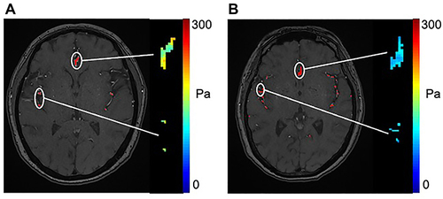 Figure 4 Shear modulus of the segmented vessel ROIs overlaid in an MRA image. The average shear modulus of ROIs for (A) the healthy volunteer and (B) the patient with lacunar infarction were 161±25 Pa and 100±11 Pa, respectively. The white pointers indicated the shear modulus of the segmented vessel ROIs.