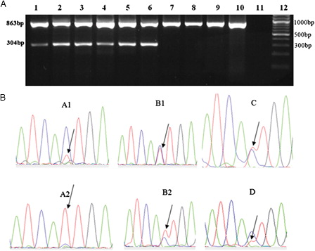 Figure 1. Patients with T315I mutation. (A) T315I mutation was detected by ASO-RT-PCR, as described. In brief, the ASO-RT-PCR protocol amplifies an 863-bp product (both mutant and wild-type alleles and serves as an internal control) and a 304-bp product (when the patient carries the T315I mutation). Lanes 1 and 2: patient A; lanes 3 and 4: patient B; lane 5: patient C; and lane 6: patient D. Lanes 7–10, 11, and 12 show patient with imatinib resistance without mutation, negative control and 100-bp size marker, respectively. (B) Direct sequencing analysis of samples A1, A2, B1, B2, C, and D are shown. As can be seen, the resistant mutated cells expanded from 20% (sample A1) to 90% (sample A2) in patient A and 50% (sample B1) to 60% (sample B2) in patient B. Patient C shows a mix of T315I mutation and wild-type ABL, each %50 and Patient D shows a mix of T315I mutation about %30 and wild-type ABL about %70 in individual samples available.